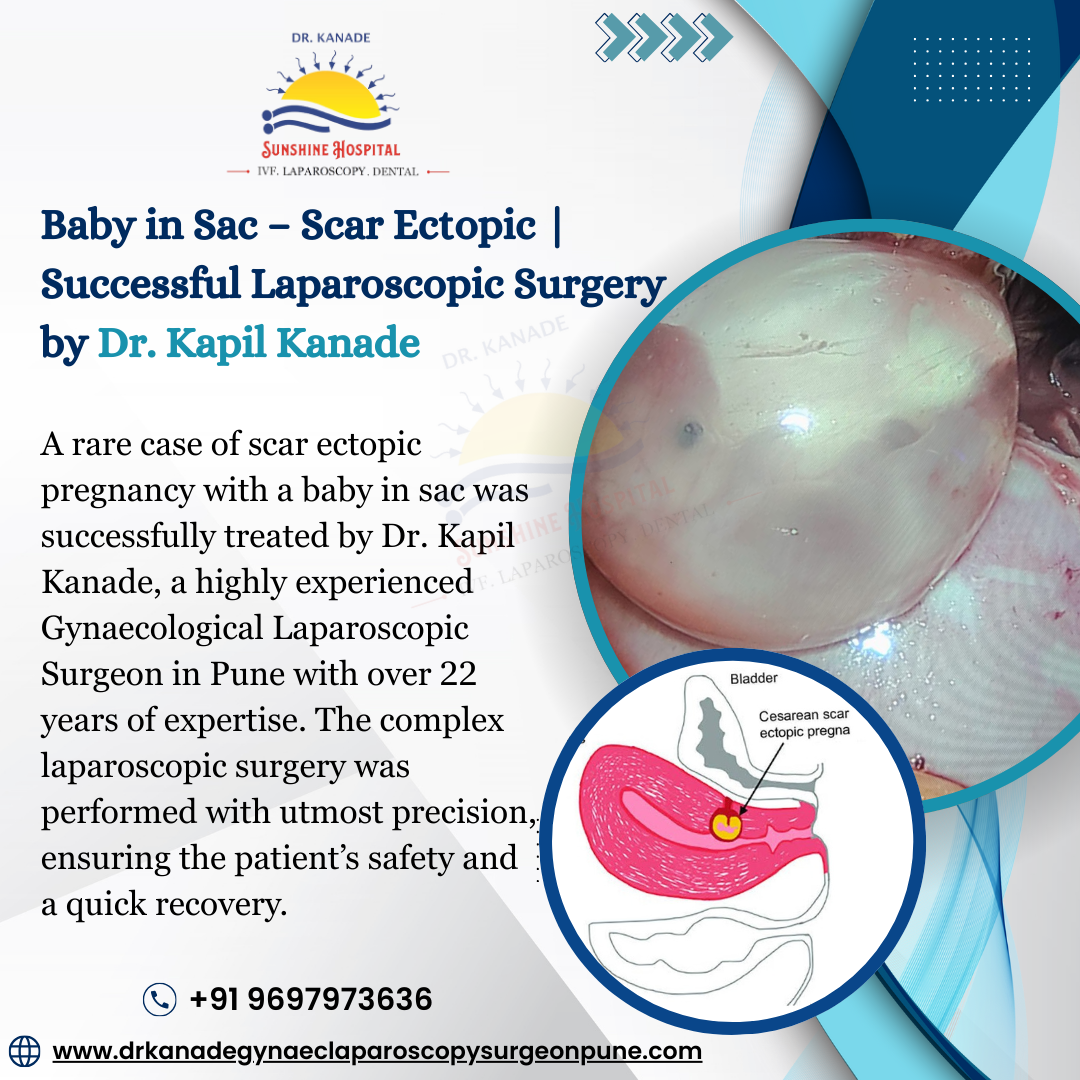 Ectopic Pregnancy Surgery | Dr. Kapil Kanade Pune